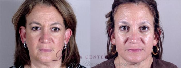 Eyelid Lift Case 1173 Before & After View 2 | Paramus, NJ | Parker Center for Plastic Surgery
