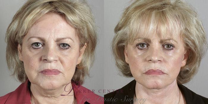 Eyelid Lift Case 1174 Before & After View 2 | Paramus, NJ | Parker Center for Plastic Surgery