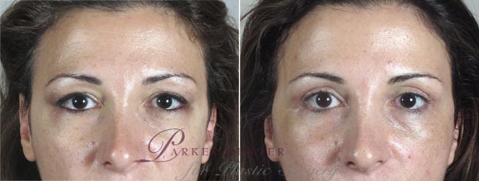 Eyelid Lift Case 1175 Before & After View 1  | Paramus, NJ | Parker Center for Plastic Surgery