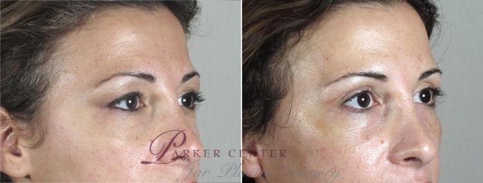 Eyelid Lift Case 1175 Before & After View 2 | Paramus, NJ | Parker Center for Plastic Surgery