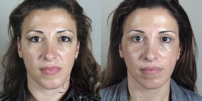 Eyelid Lift Case 1175 Before & After View 3 | Paramus, NJ | Parker Center for Plastic Surgery