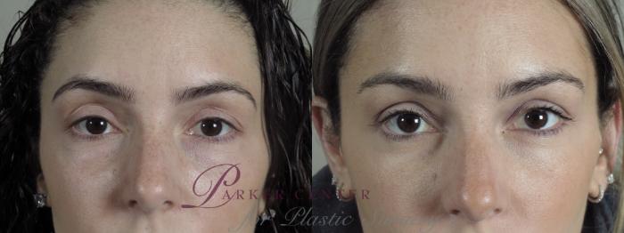 Eyelid Lift Case 1187 Before & After CLOSE-UP VIEW  | Paramus, NJ | Parker Center for Plastic Surgery