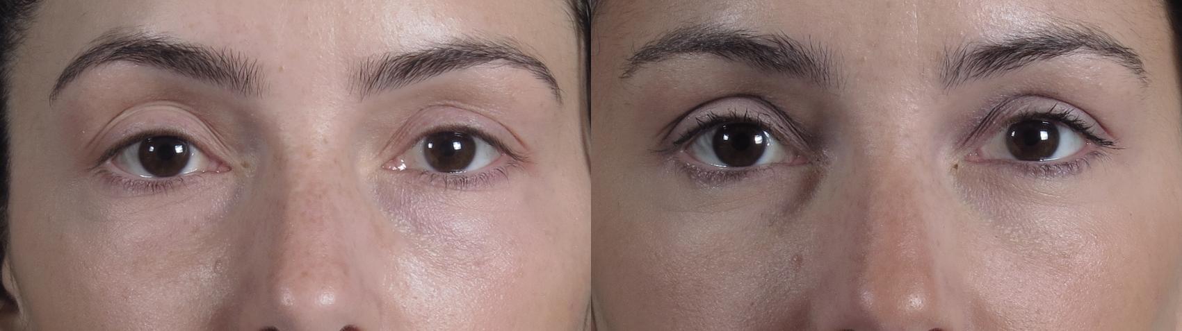 Eyelid Lift Case 1187 Before & After Front | Paramus, New Jersey | Parker Center for Plastic Surgery