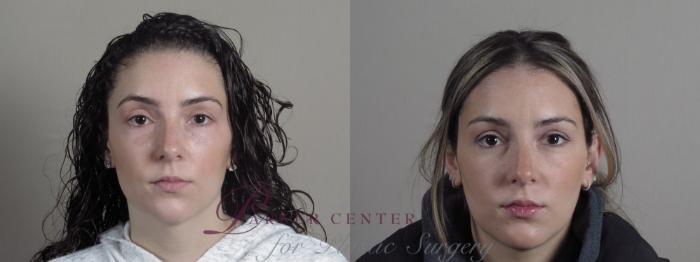 Eyelid Lift Case 1187 Before & After Front | Paramus, NJ | Parker Center for Plastic Surgery