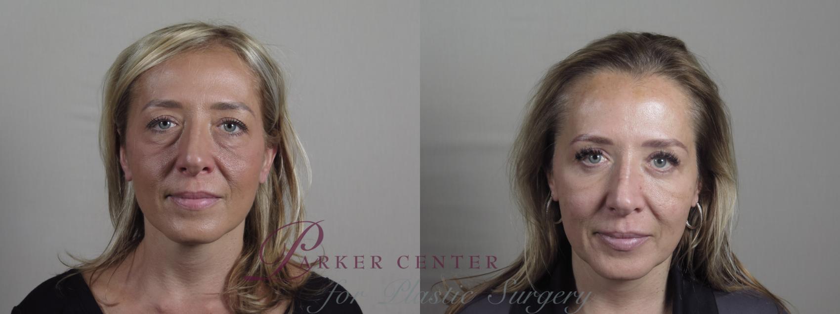 Eyelid Lift Case 1212 Before & After View #1  | Paramus, NJ | Parker Center for Plastic Surgery