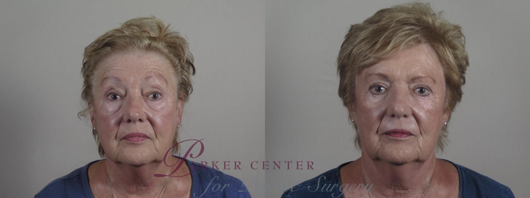Eyelid Lift Case 1213 Before & After View #1  | Paramus, NJ | Parker Center for Plastic Surgery