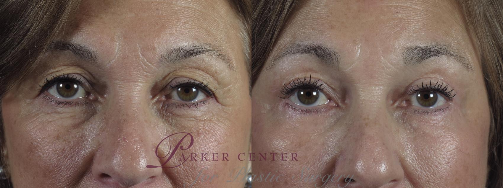 Eyelid Lift Case 1291 Before & After Front | Paramus, NJ | Parker Center for Plastic Surgery