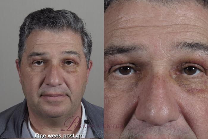 Eyelid Lift Case 1348 Before & After 2 weeks  | Paramus, New Jersey | Parker Center for Plastic Surgery
