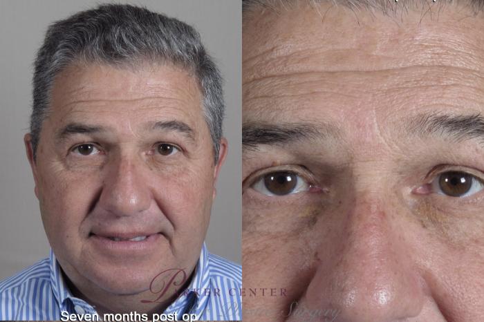 Eyelid Lift Case 1348 Before & After months  | Paramus, New Jersey | Parker Center for Plastic Surgery