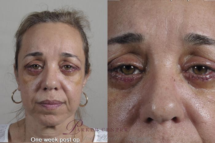 Eyelid Lift Case 1349 Before & After 1 week  | Paramus, New Jersey | Parker Center for Plastic Surgery