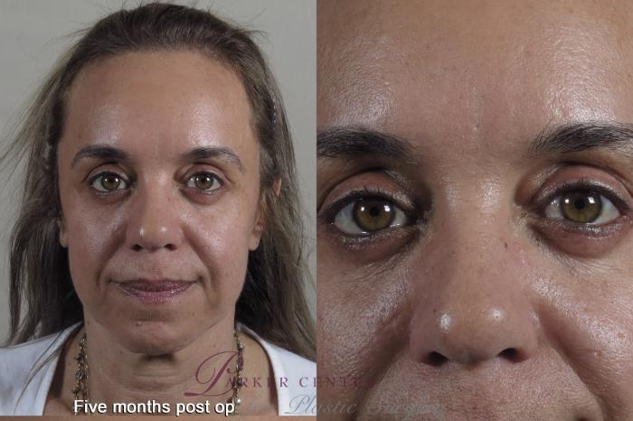 Eyelid Lift Case 1349 Before & After months  | Paramus, New Jersey | Parker Center for Plastic Surgery