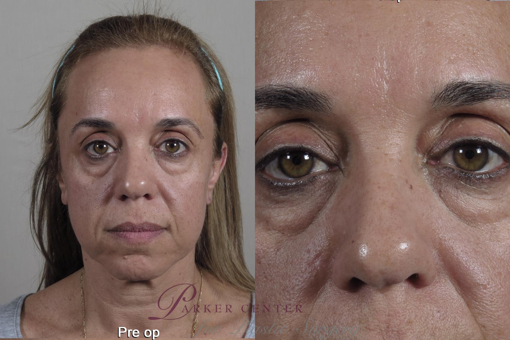 Eyelid Lift Case 1349 Before & After pre op  | Paramus, New Jersey | Parker Center for Plastic Surgery