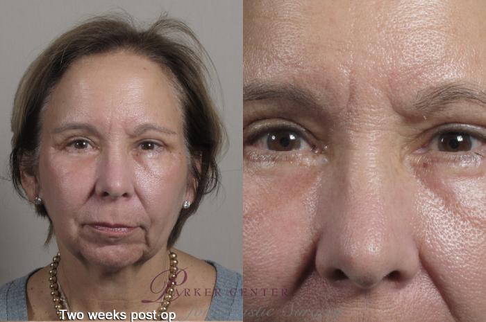 Eyelid Lift Case 1351 Before & After 2 weeks  | Paramus, New Jersey | Parker Center for Plastic Surgery