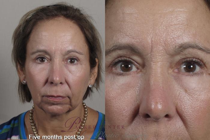 Eyelid Lift Case 1351 Before & After months  | Paramus, New Jersey | Parker Center for Plastic Surgery