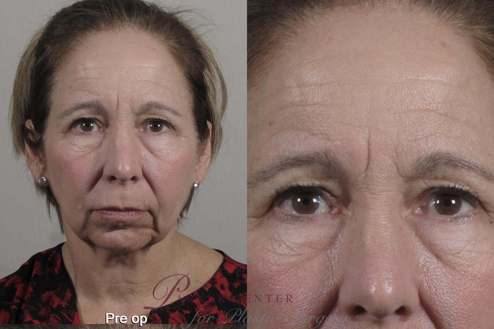 Eyelid Lift Case 1351 Before & After pre op  | Paramus, New Jersey | Parker Center for Plastic Surgery