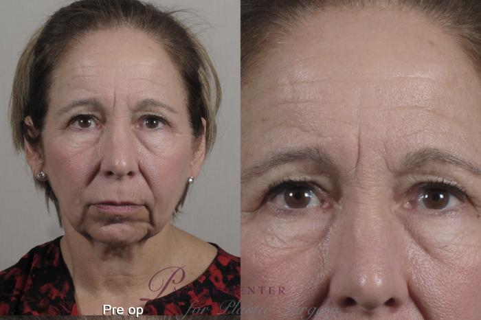 Eyelid Lift Case 1351 Before & After pre op  | Paramus, New Jersey | Parker Center for Plastic Surgery