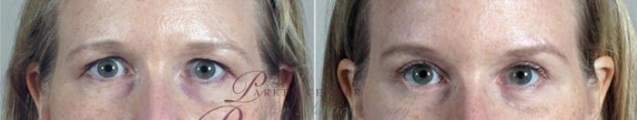 Eyelid Lift Case 1385 Before & After Front | Paramus, NJ | Parker Center for Plastic Surgery