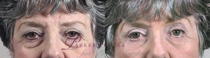Eyelid Lift Case 1388 Before & After Front | Paramus, NJ | Parker Center for Plastic Surgery