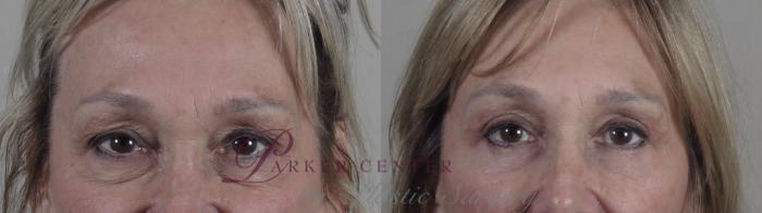 Eyelid Lift Case 1389 Before & After Front | Paramus, New Jersey | Parker Center for Plastic Surgery