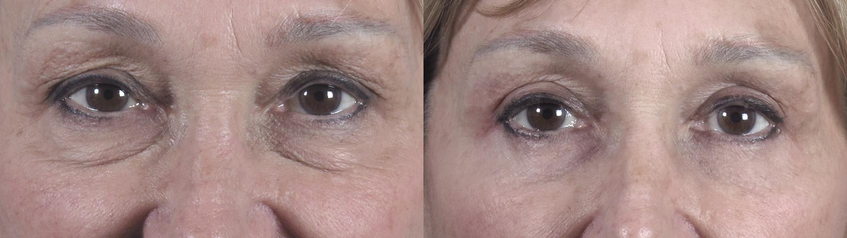 Eyelid Lift Case 1389 Before & After Front View | Paramus, New Jersey | Parker Center for Plastic Surgery