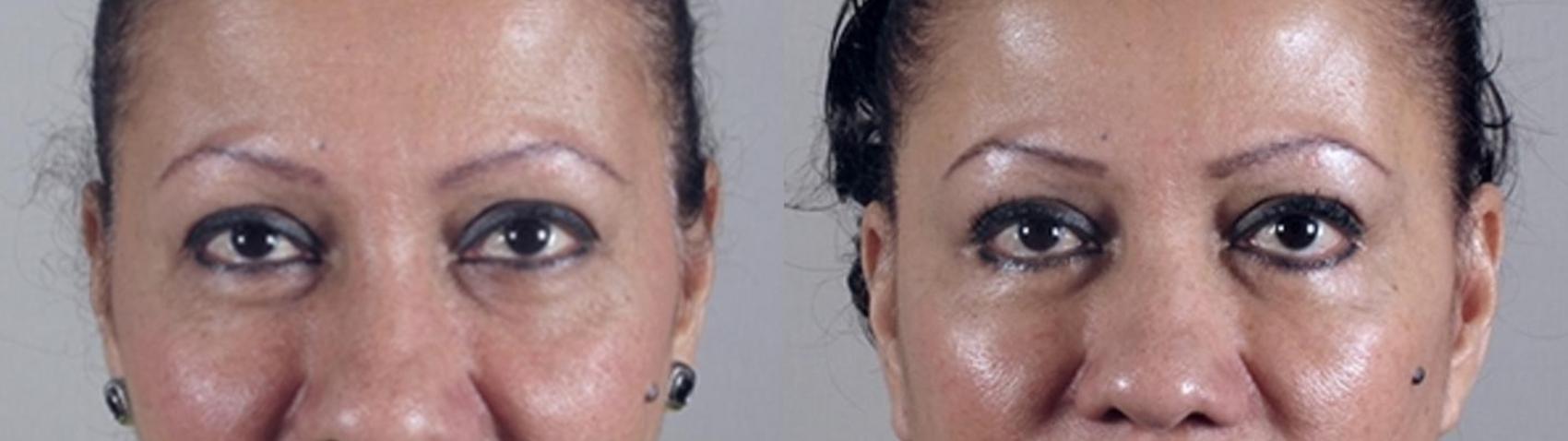 Eyelid Lift Case 1420 Before & After Front | Paramus, New Jersey | Parker Center for Plastic Surgery