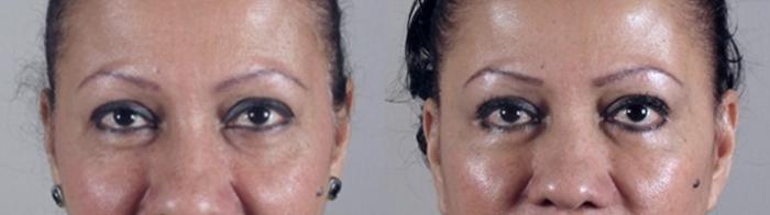 Eyelid Lift Case 1420 Before & After Front | Paramus, New Jersey | Parker Center for Plastic Surgery