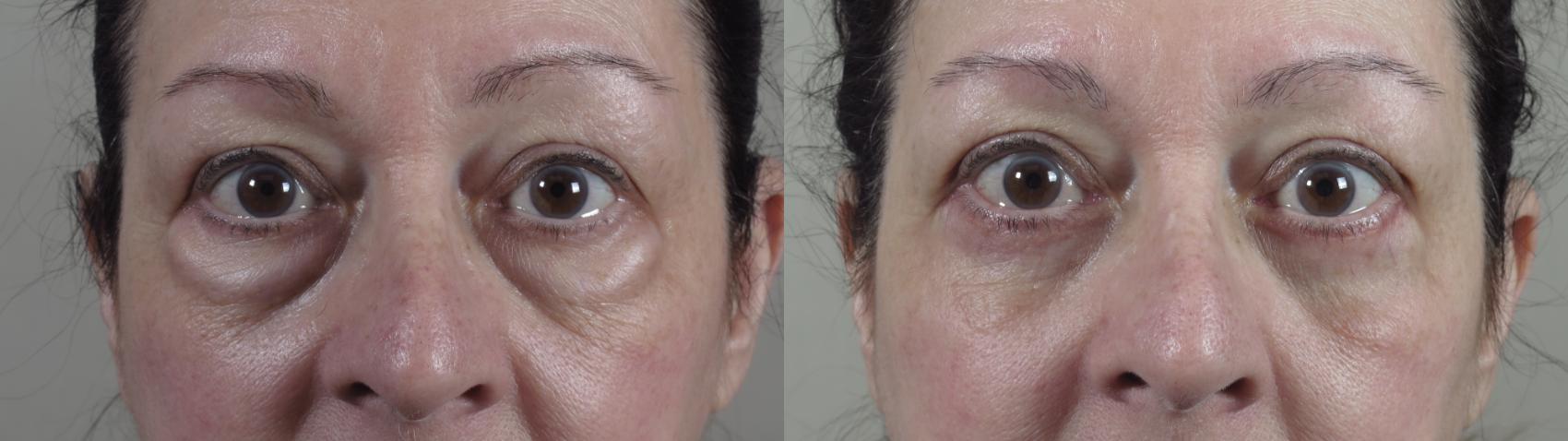 Eyelid Lift Case 1426 Before & After zoomed in  | Paramus, New Jersey | Parker Center for Plastic Surgery