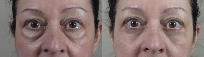 Eyelid Lift Case 1426 Before & After zoomed in  | Paramus, New Jersey | Parker Center for Plastic Surgery