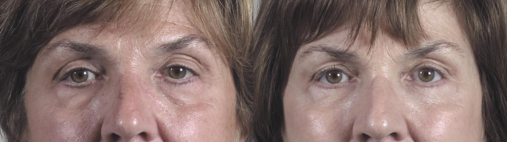 Eyelid Lift Case 1434 Before & After Front | Paramus, New Jersey | Parker Center for Plastic Surgery