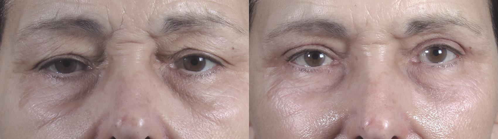 Eyelid Lift Case 1466 Before & After Front | Paramus, New Jersey | Parker Center for Plastic Surgery