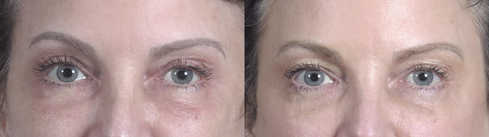 Eyelid Lift Case 1467 Before & After Front | Paramus, New Jersey | Parker Center for Plastic Surgery