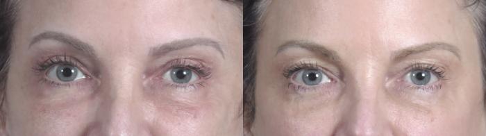 Eyelid Lift Case 1467 Before & After Front | Paramus, New Jersey | Parker Center for Plastic Surgery