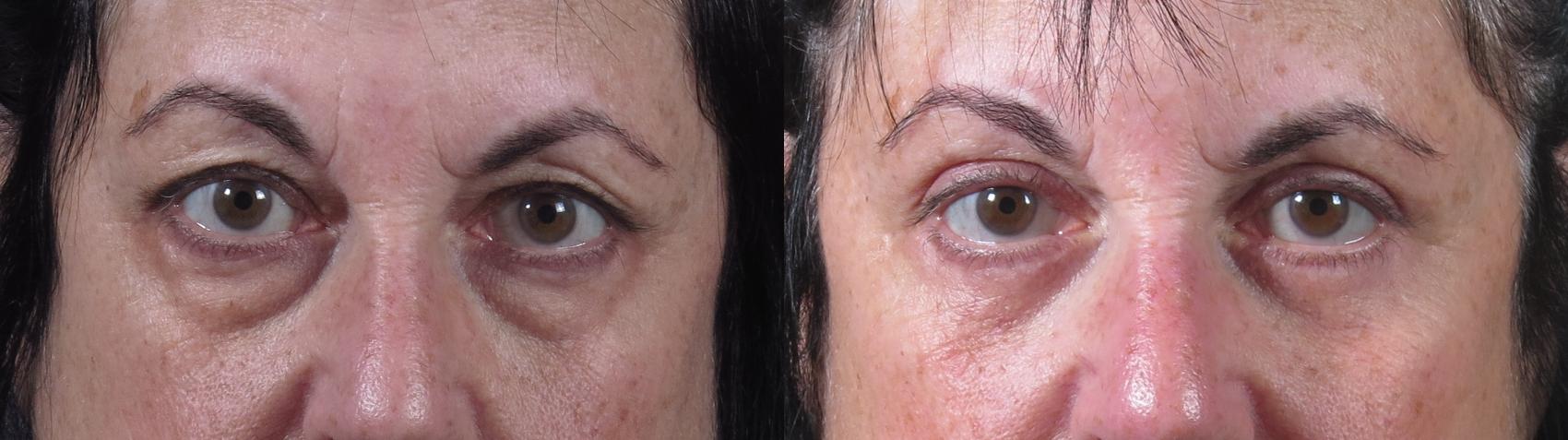 Eyelid Lift Case 1507 Before & After Front | Paramus, New Jersey | Parker Center for Plastic Surgery