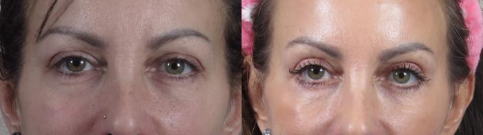 Eyelid Lift Case 1509 Before & After Front | Paramus, New Jersey | Parker Center for Plastic Surgery