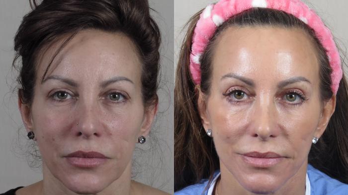 Eyelid Lift Case 1509 Before & After front1 | Paramus, New Jersey | Parker Center for Plastic Surgery