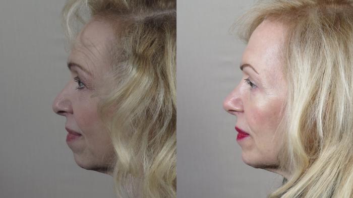 Eyelid Lift Case 1535 Before & After left side | Paramus, New Jersey | Parker Center for Plastic Surgery