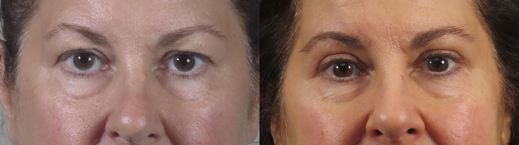 Eyelid Lift Case 1548 Before & After Front | Paramus, New Jersey | Parker Center for Plastic Surgery