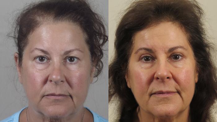 Eyelid Lift Case 1564 Before & After Front | Paramus, New Jersey | Parker Center for Plastic Surgery