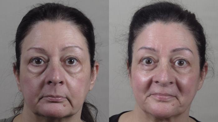 Eyelid Lift Case 1565 Before & After 2 | Paramus, New Jersey | Parker Center for Plastic Surgery