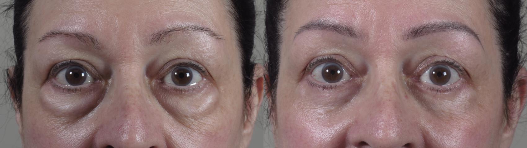 Eyelid Lift Case 1565 Before & After Front | Paramus, New Jersey | Parker Center for Plastic Surgery