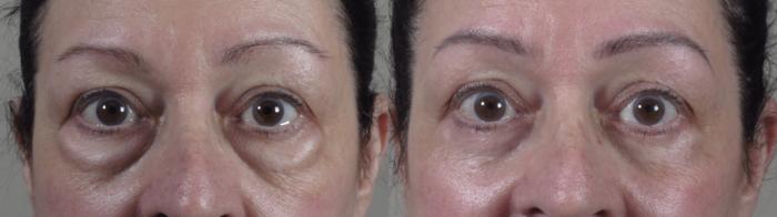 Eyelid Lift Case 1565 Before & After Front | Paramus, New Jersey | Parker Center for Plastic Surgery