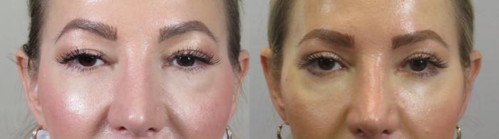 Eyelid Lift Case 1588 Before & After Front | Paramus, New Jersey | Parker Center for Plastic Surgery