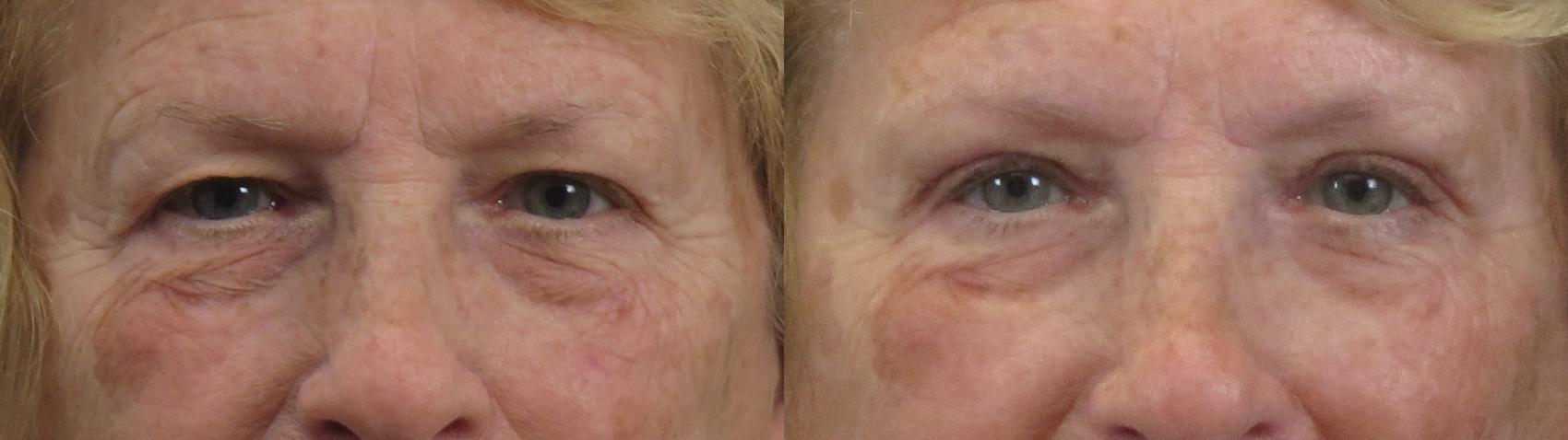 Eyelid Lift Case 1595 Before & After Front | Paramus, New Jersey | Parker Center for Plastic Surgery