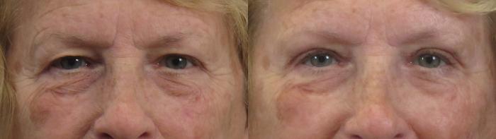 Eyelid Lift Case 1595 Before & After Front | Paramus, New Jersey | Parker Center for Plastic Surgery