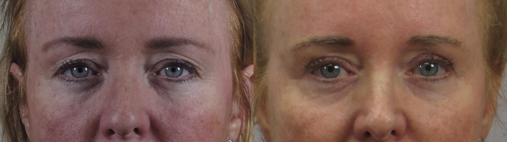 Eyelid Lift Case 1596 Before & After Front | Paramus, New Jersey | Parker Center for Plastic Surgery