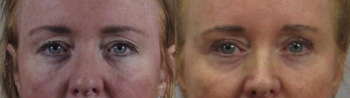 Eyelid Lift Case 1596 Before & After Front | Paramus, New Jersey | Parker Center for Plastic Surgery