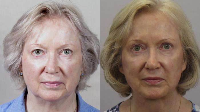Eyelid Lift Case 1619 Before & After front 1 | Paramus, New Jersey | Parker Center for Plastic Surgery