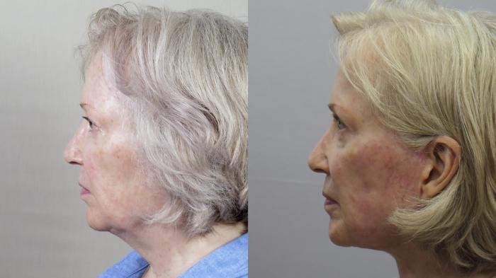 Eyelid Lift Case 1619 Before & After Left Side | Paramus, New Jersey | Parker Center for Plastic Surgery