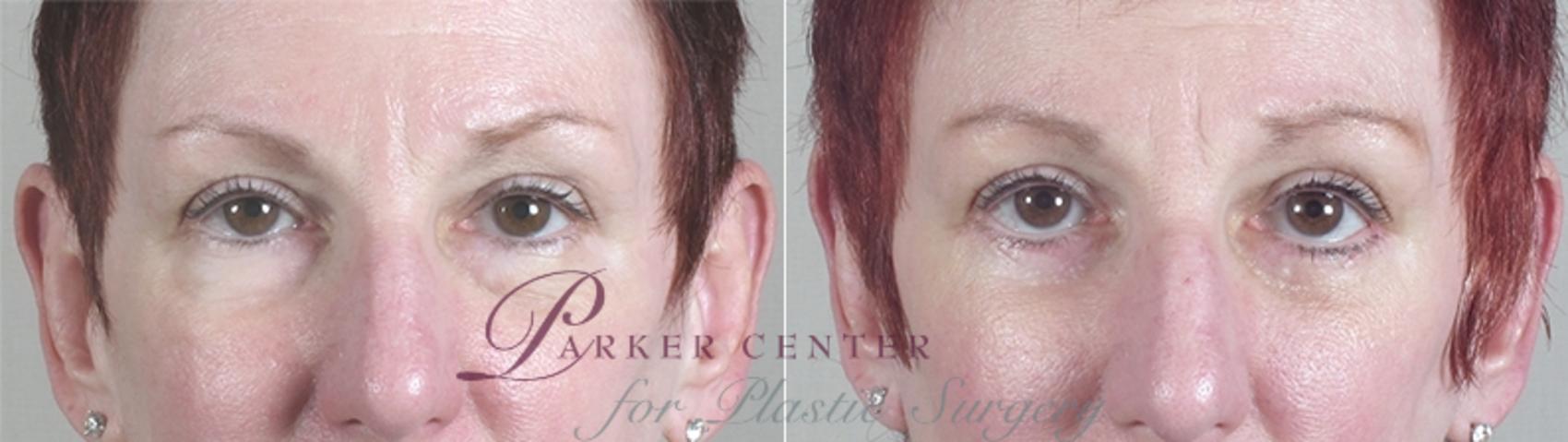 Eyelid Lift Case 26 Before & After View #11 | Paramus, NJ | Parker Center for Plastic Surgery