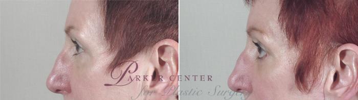 Eyelid Lift Case 26 Before & After View #4 | Paramus, NJ | Parker Center for Plastic Surgery